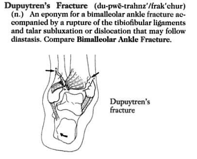 dupuytren's fracture definition