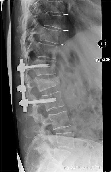 lateral lumbar spine