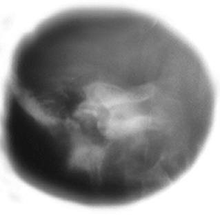 Radiography of Skull Devices - wikiRadiography