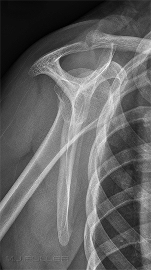 lateral scapula
