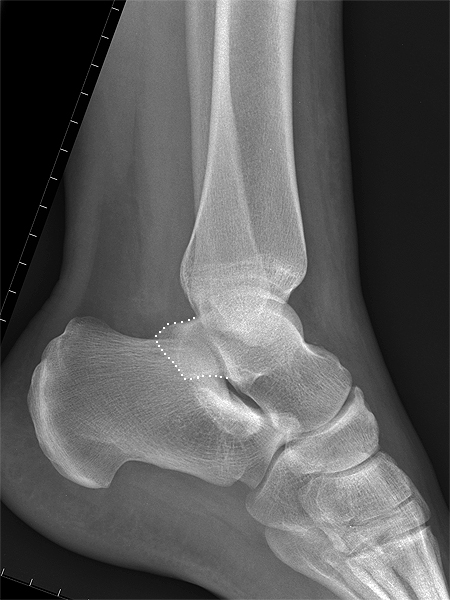 Large Posterior Process of Talus