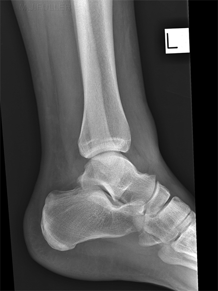 ANKLE EFFUSION