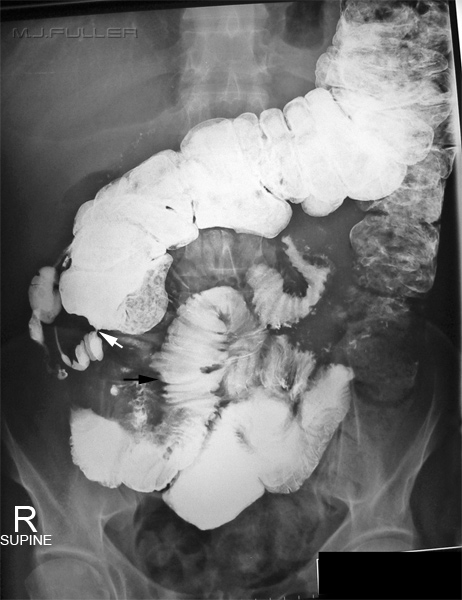 Ulcerative Colitis and Crohn's Disease - wikiRadiography