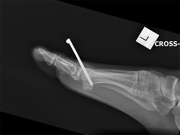 nail in foot