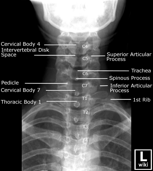 Radiographic Anatomy - Cervical Spine AP