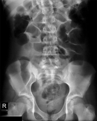 Small Bowel Obstruction - wikiRadiography