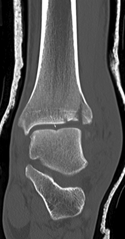 talar dome fracture