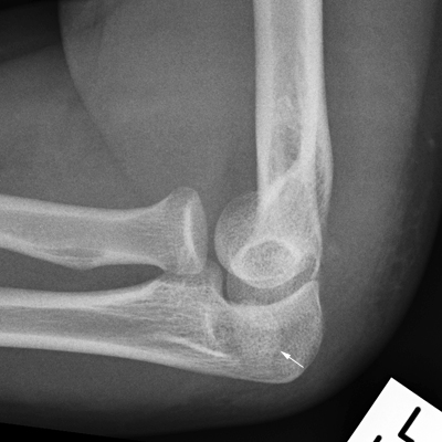 medial epicondyle fracture post redn