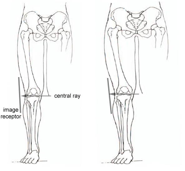 lateral knee tube angulation