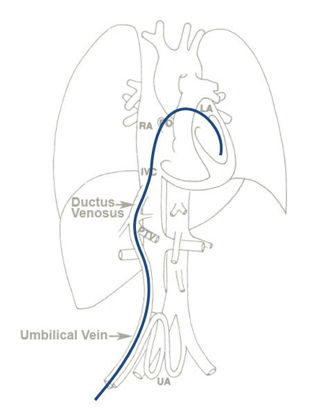 UVC through foramen ovale