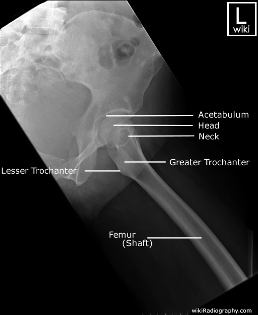 Radiographic Anatomy - Femur - Lateral - Proximal