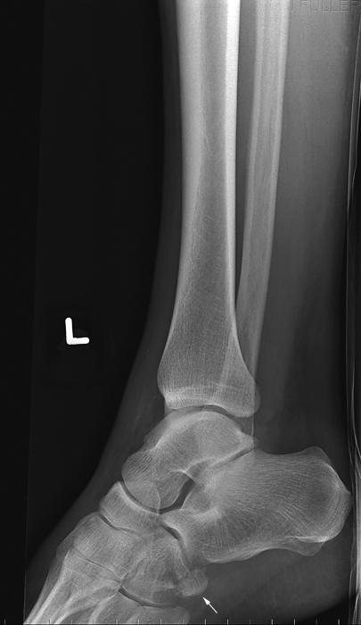 LATERAL ANKLE