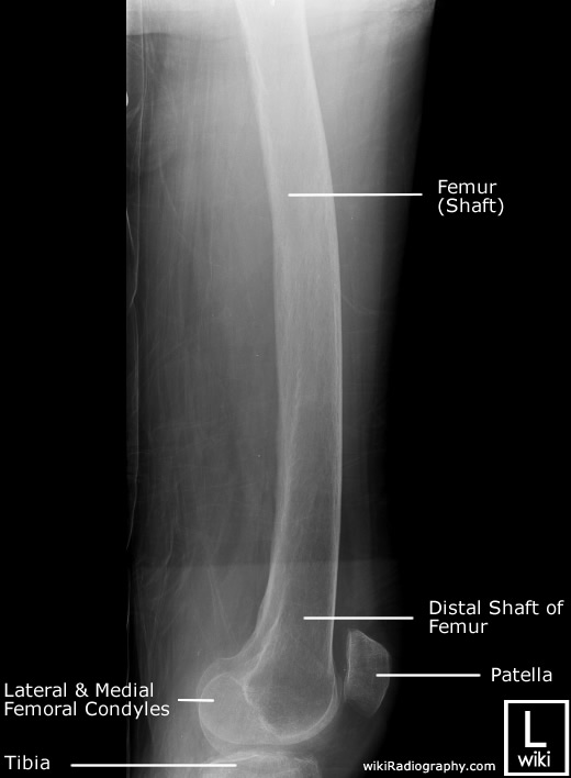 Radiographic Anatomy - Femur - Lateral - Distal