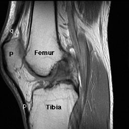 Normal knee - sagittal