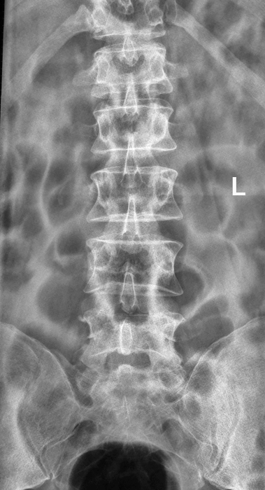 AP lumbar spine