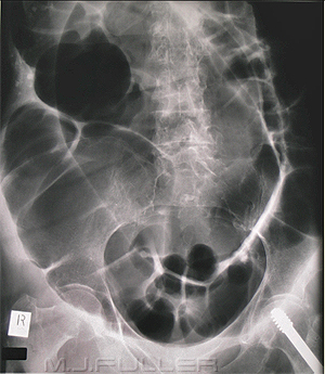 Large Bowel Obstruction - wikiRadiography