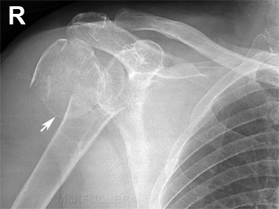 ap shoulder NOH fracture