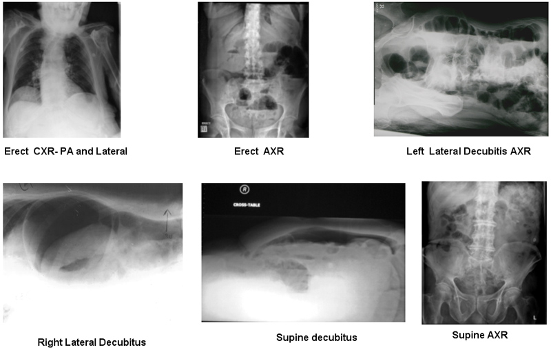Pneumoperitoneum- Radiographic Techniques - wikiRadiography