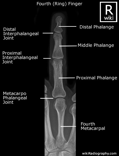 Fourth (Ring) Finger - AP - Radiographic Anatomy