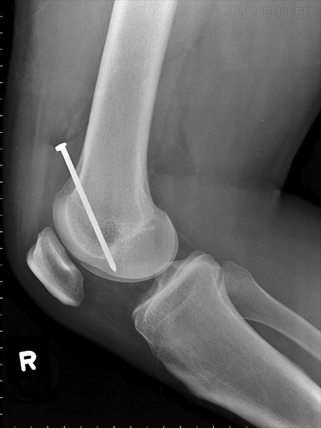 LATERAL KNEE