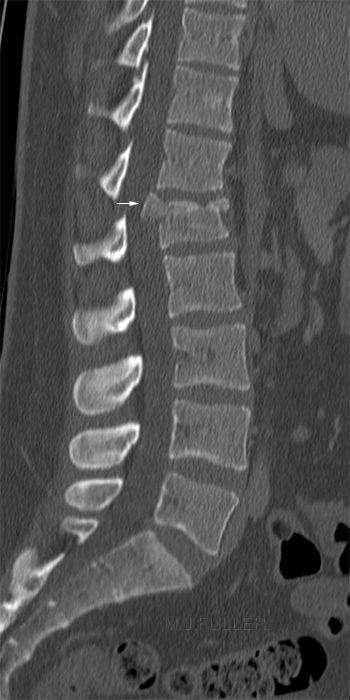CT lumbar spine with retropulsion