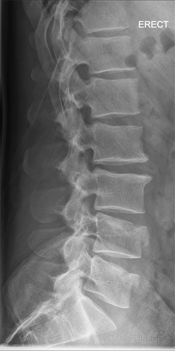 erect lateral lumbar spine