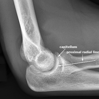 lateral elbow- compound error