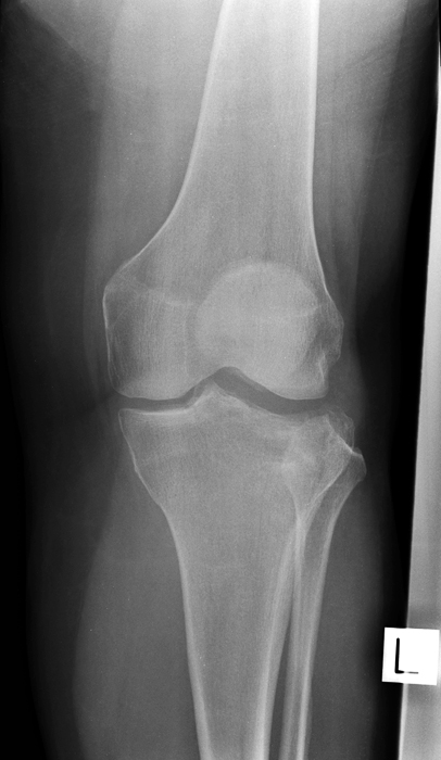 AP knee