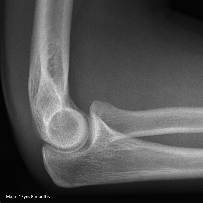 right elbow. male. 17 years , 8 months