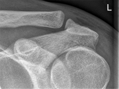 AC joint radiography