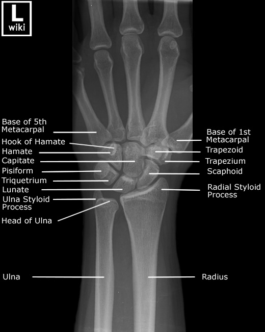 Radiographic Anatomy - Wrist AP