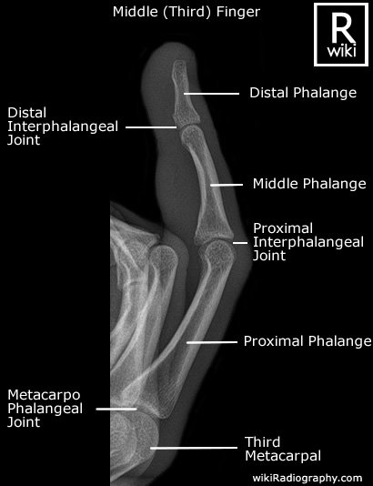 Third (Middle) Finger - Lateral - Radiographic Anatomy