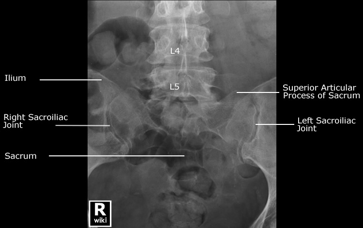 Radiographic Anatomy - Sacroiliac Joint AP