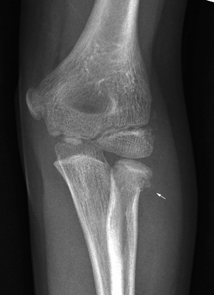 radial neck fracture