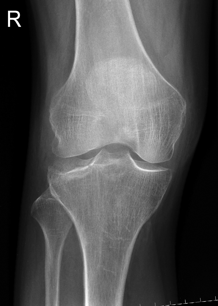 Imaging Tibial Plateau Fractures - wikiRadiography