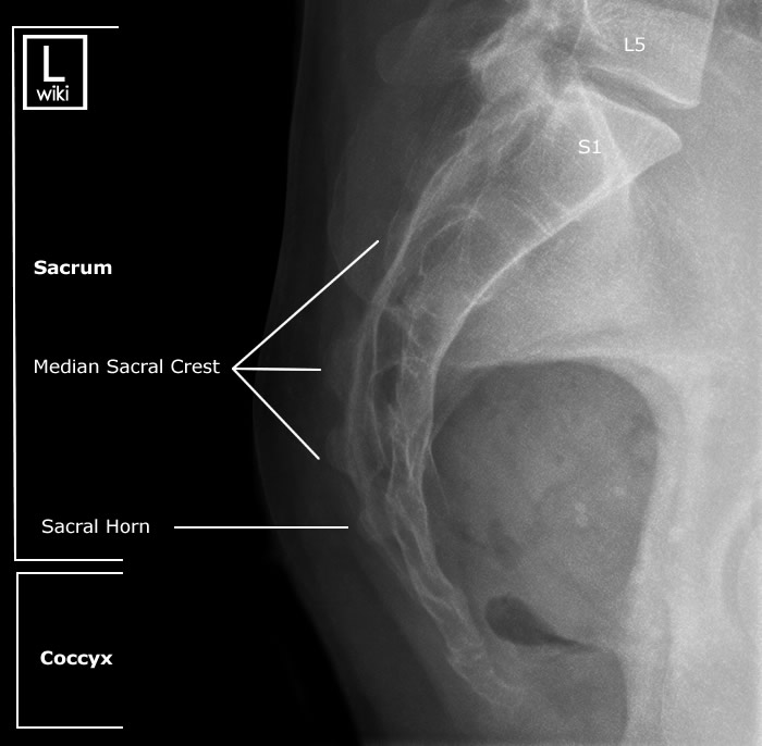 Radiographic Anatomy - Sacrum - Lateral