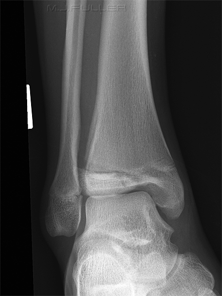 ankle trauma 3 obl