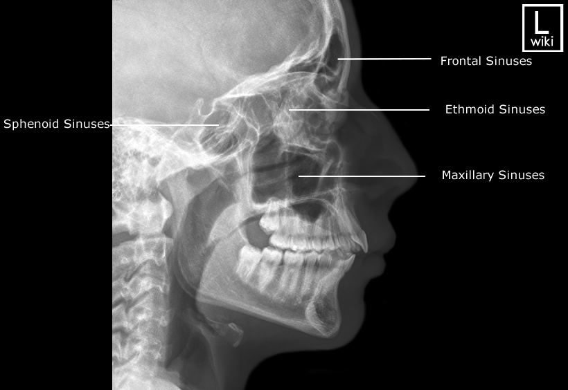 Radiographic Anatomy - Sinuses - Lateral