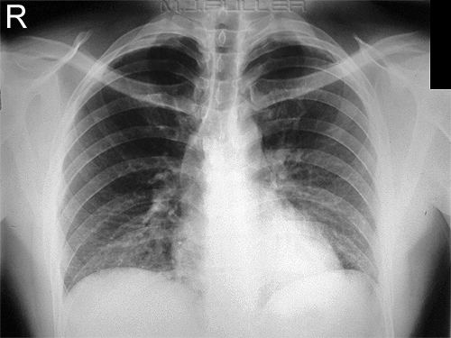 Notes on Chest Radiography - wikiRadiography