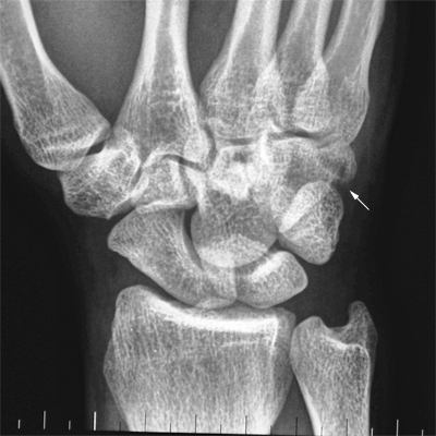 hamate fracture