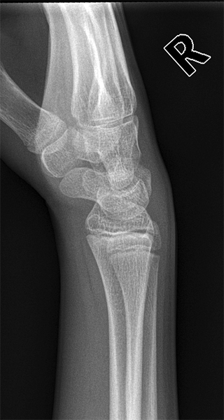 LATERAL WRIST