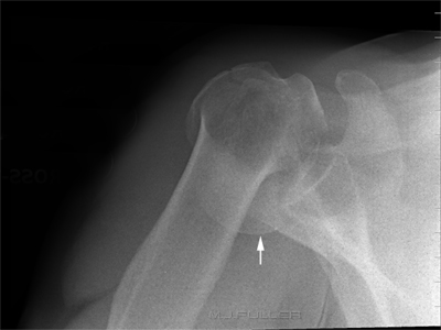 shoulder fracture dislocation