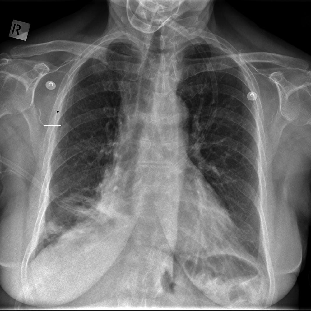 Pneumothorax Self Test Case 1 Answer - wikiRadiography