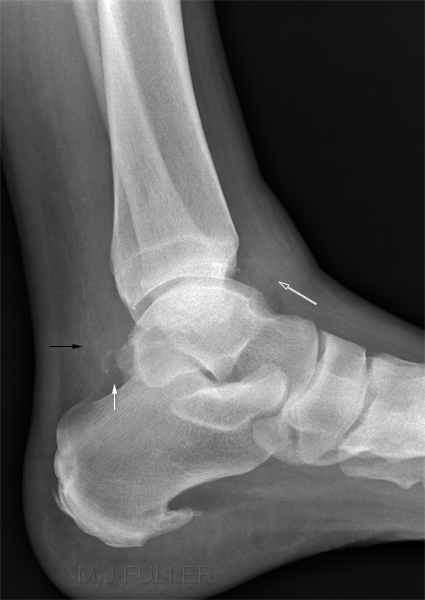 posterior process of talus fracture