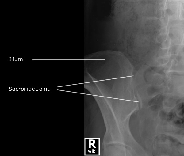 Radiographic Anatomy - Sacroiliac Joint Oblique