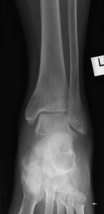 5th MT fracture