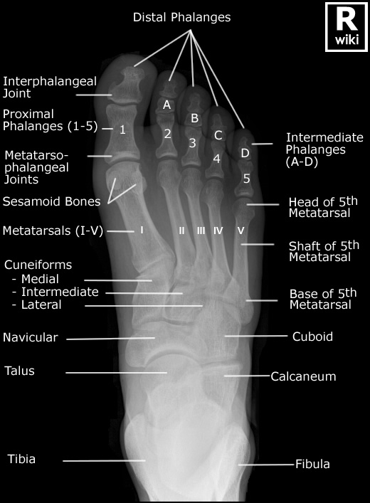 Nutcracker Fracture of the Cuboid - wikiRadiography