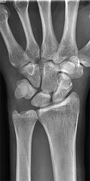 scaphoid fracture pa