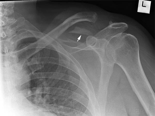 coracoclavicular ligament