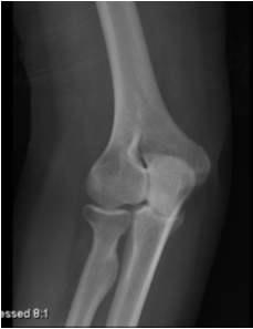 lateral oblique elbow
